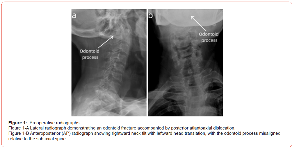 Click here to view Large Figure 1 irispublishers-openaccess-orthopedics-research