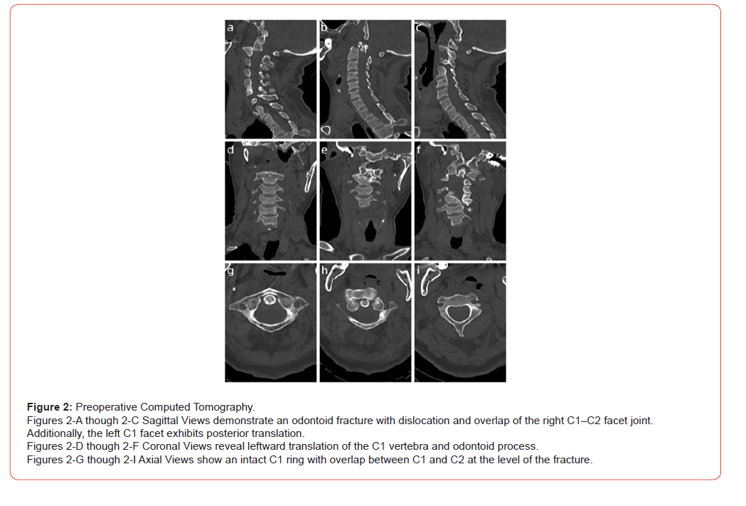 Click here to view Large Figure 2 irispublishers-openaccess-orthopedics-research