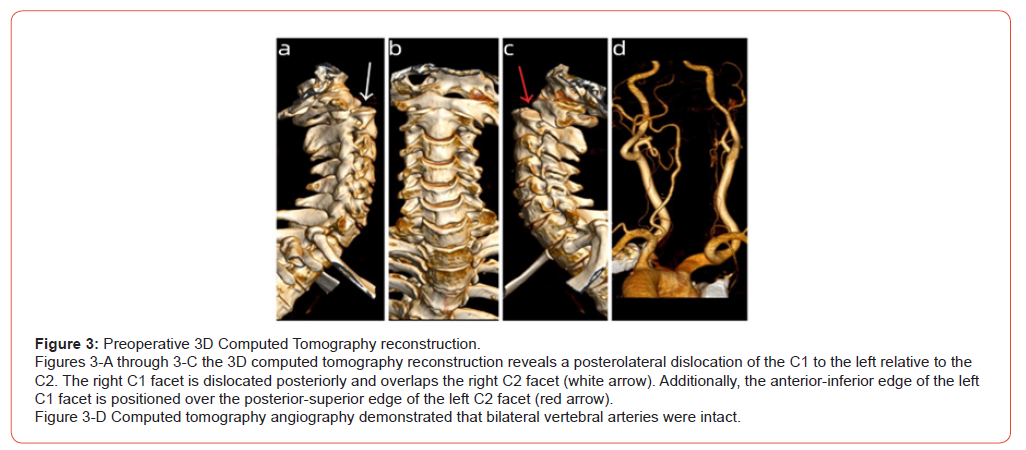 Click here to view Large Figure 3 irispublishers-openaccess-orthopedics-research