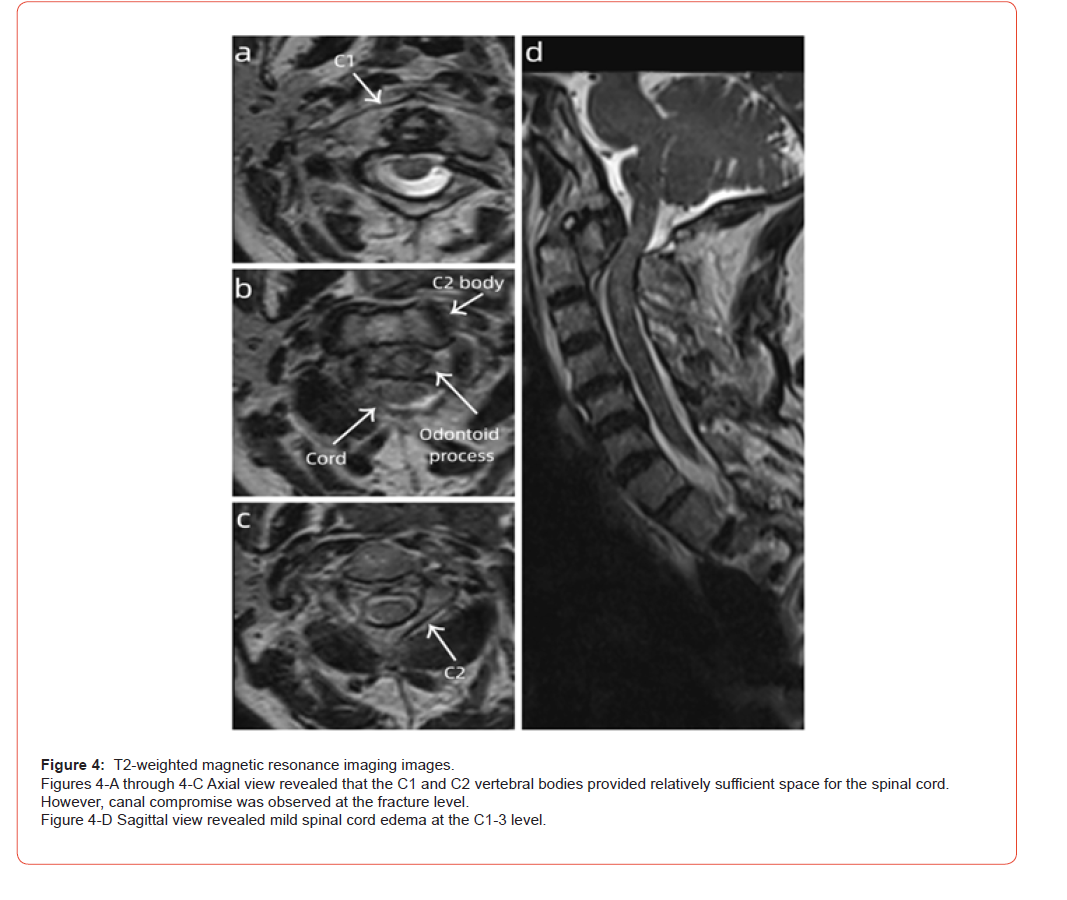 Click here to view Large Figure 4 irispublishers-openaccess-orthopedics-research