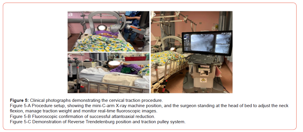 Click here to view Large Figure 5 irispublishers-openaccess-orthopedics-research