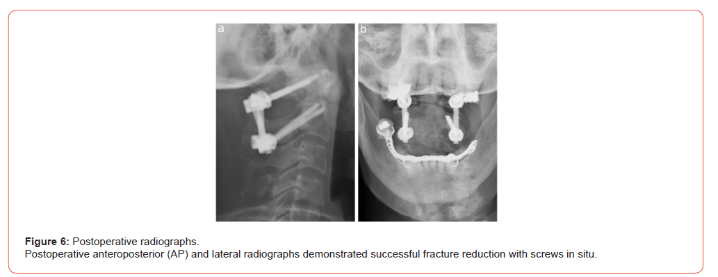 Click here to view Large Figure 6 irispublishers-openaccess-orthopedics-research