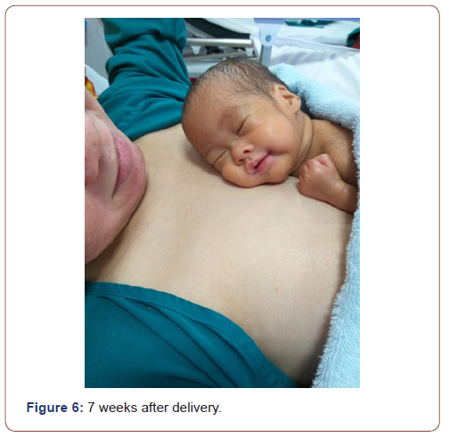 irispublishers-openaccess-pediatrics-neonatal-care