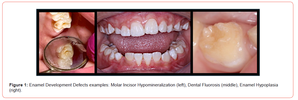 Click here to view Large Figure 1 irispublishers-openaccess-pediatrics-neonatal-care