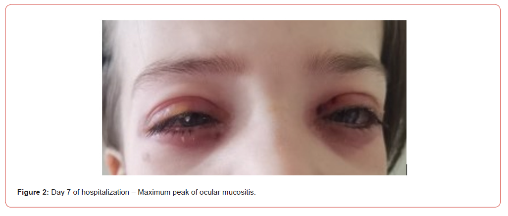 Click here to view Large Figure 2 irispublishers-openaccess-pediatrics-neonatal-care