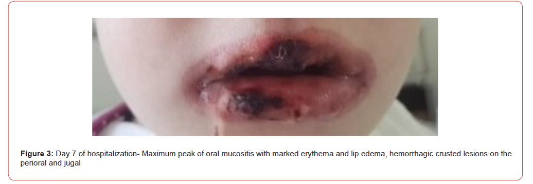 Click here to view Large Figure 3 irispublishers-openaccess-pediatrics-neonatal-care