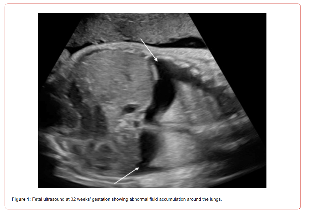 Click here to view Large Figure 1 irispublishers-openaccess-pediatrics-neonatal-care