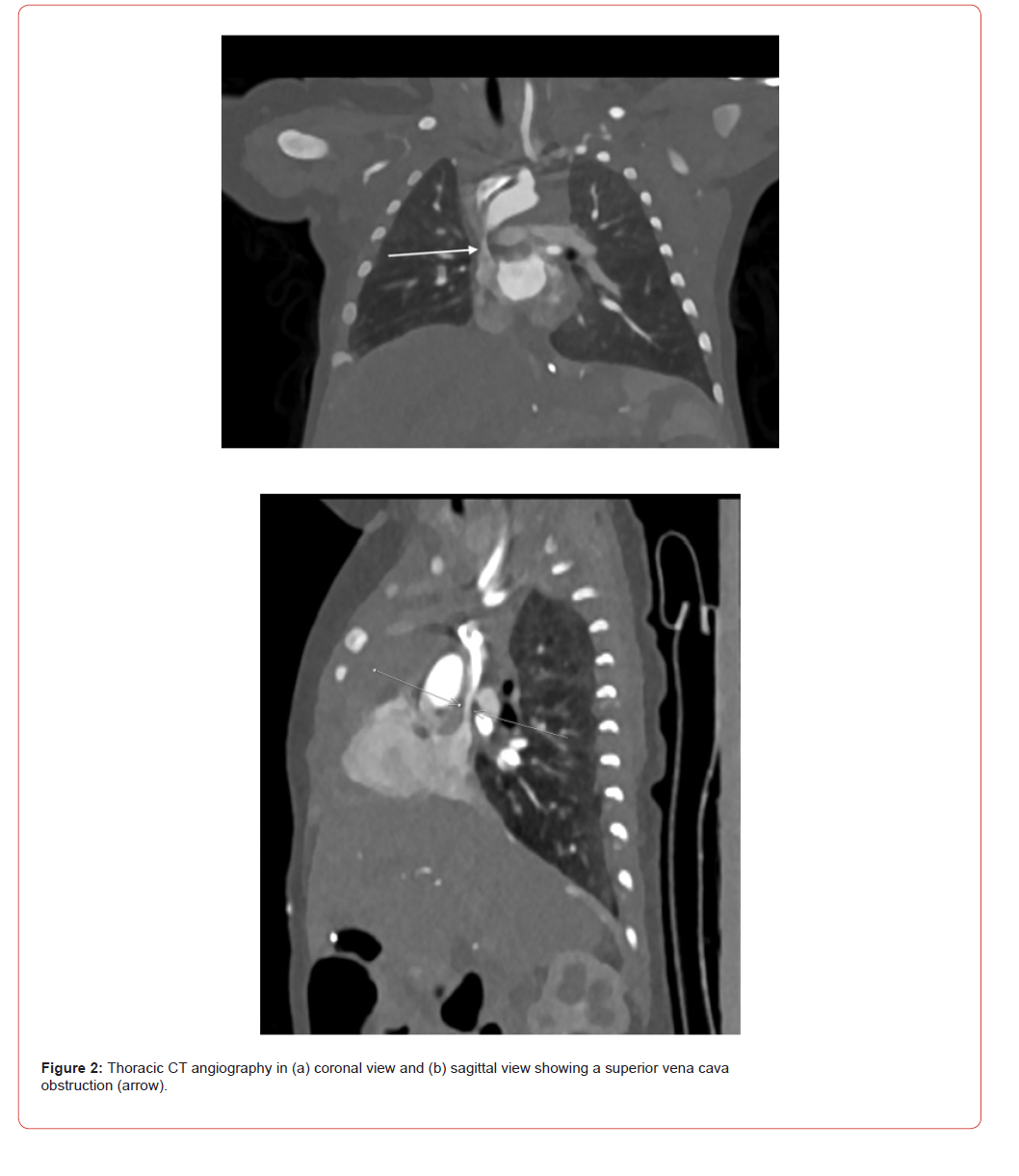 Click here to view Large Figure 2 irispublishers-openaccess-pediatrics-neonatal-care