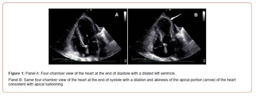 Click here to view Large Figure 1 irispublishers-openaccess-cardiovascular-research
