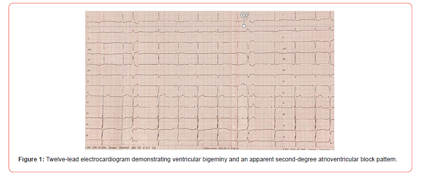 Click here to view Large Figure 1 irispublishers-openaccess-cardiovascular-research