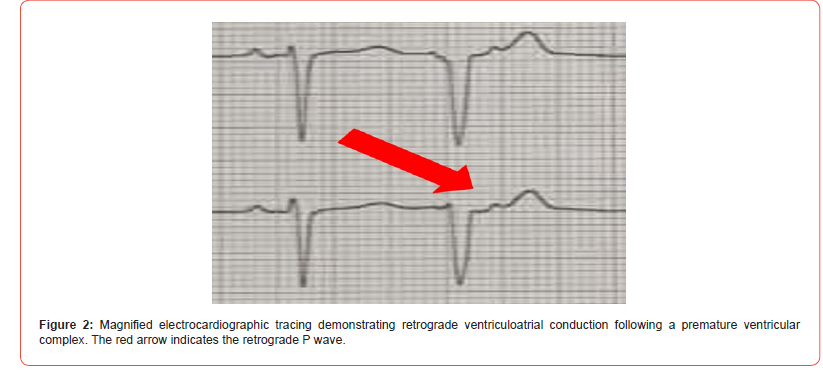 Click here to view Large Figure 2 irispublishers-openaccess-cardiovascular-research