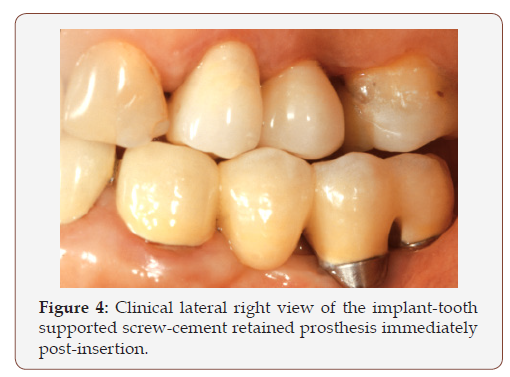 irispublishers-openaccess-dentistry-oral-health