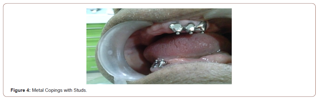 irispublishers-openaccess-dentistry-oral-health