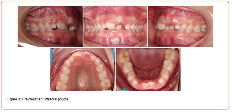 Click here to view Large Figure 2 irispublishers-openaccess-dentistry-oral-health