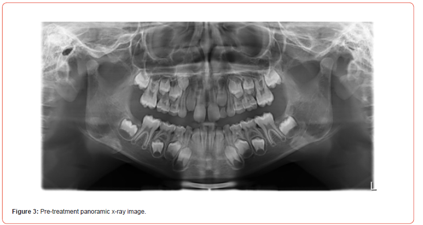 Click here to view Large Figure 3 irispublishers-openaccess-dentistry-oral-health