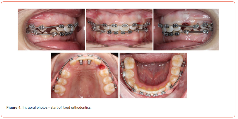 Click here to view Large Figure 4 irispublishers-openaccess-dentistry-oral-health