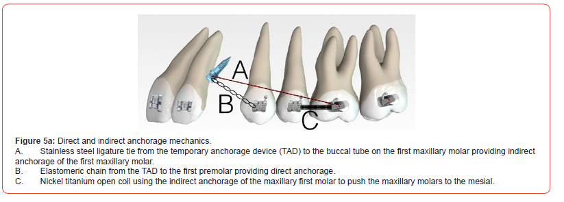 Click here to view Large Figure 5a irispublishers-openaccess-dentistry-oral-health