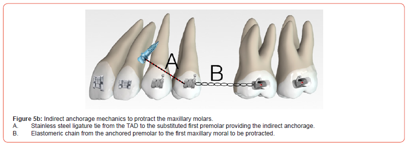 Click here to view Large Figure 5b irispublishers-openaccess-dentistry-oral-health