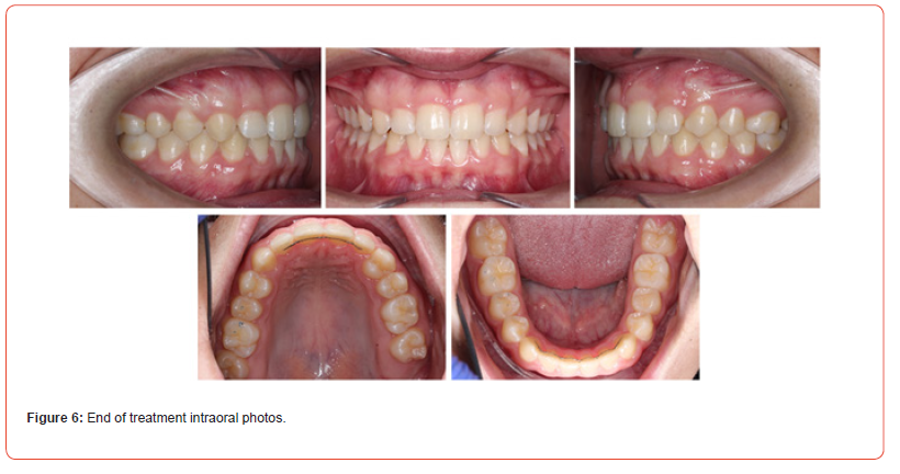 Click here to view Large Figure 6 irispublishers-openaccess-dentistry-oral-health