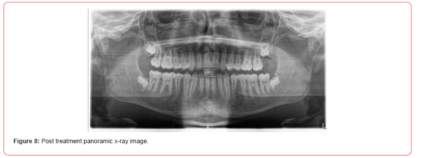 Click here to view Large Figure 8 irispublishers-openaccess-dentistry-oral-health