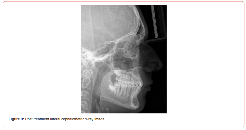 Click here to view Large Figure 9 irispublishers-openaccess-dentistry-oral-health