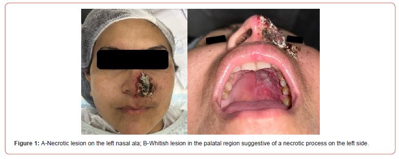 Click here to view Large Figure 1 irispublishers-openaccess-dentistry-oral-health