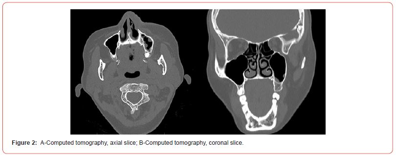 Click here to view Large Figure 2 irispublishers-openaccess-dentistry-oral-health
