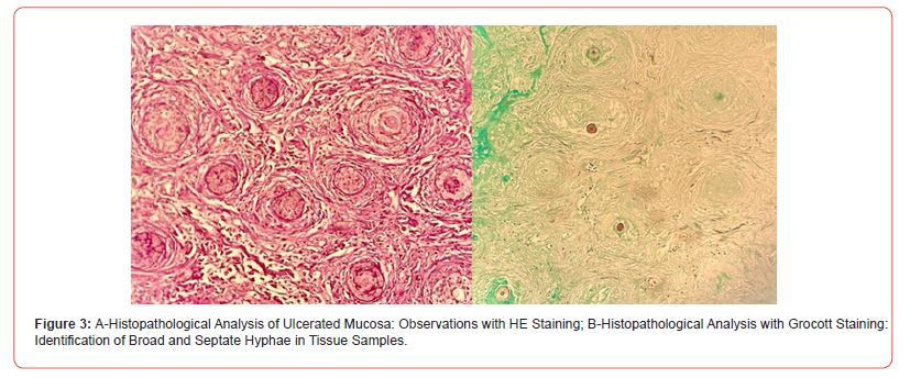 Click here to view Large Figure 3 irispublishers-openaccess-dentistry-oral-health