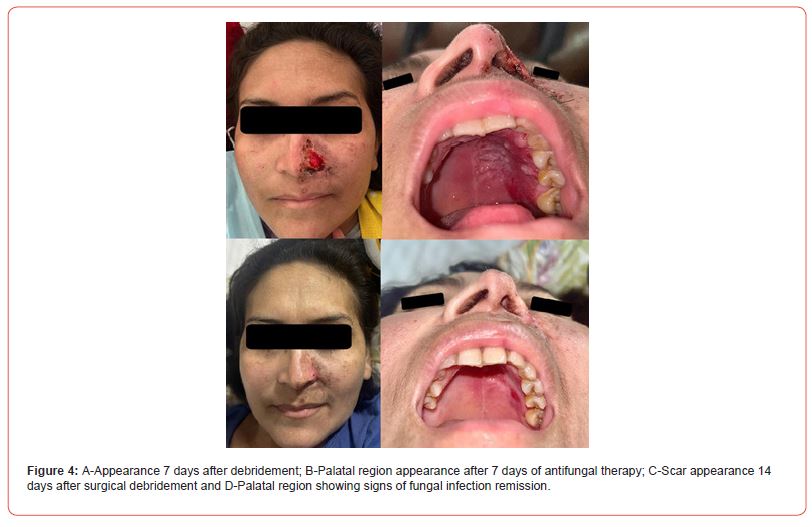 Click here to view Large Figure 4 irispublishers-openaccess-dentistry-oral-health