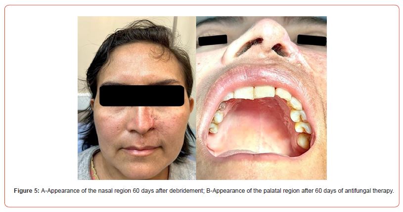 Click here to view Large Figure 5 irispublishers-openaccess-dentistry-oral-health