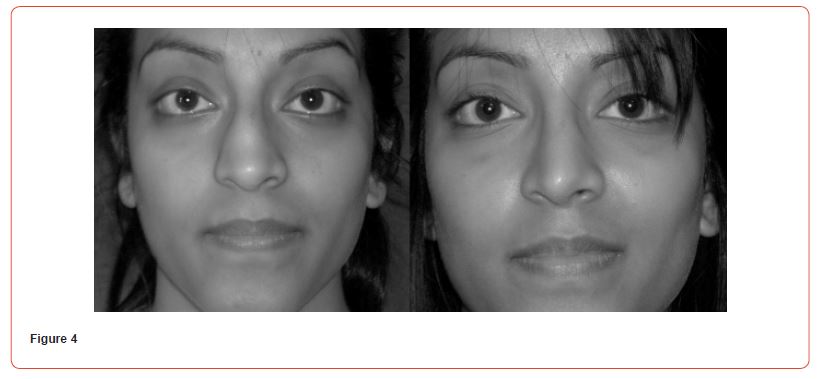 Click here to view Large Figure 4 irispublishers-openaccess-dentistry-oral-health