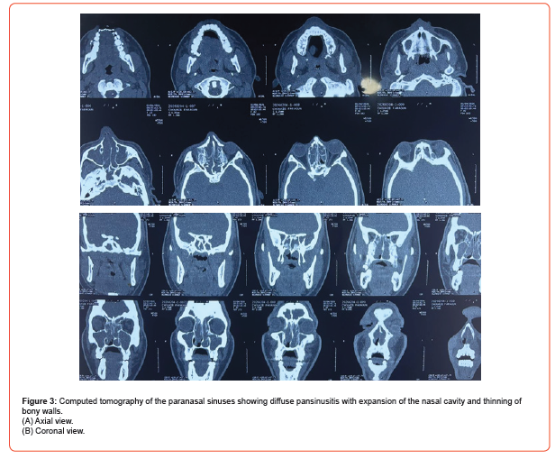 Click here to view Large Figure 3 irispublishers-openaccess-dentistry-oral-health