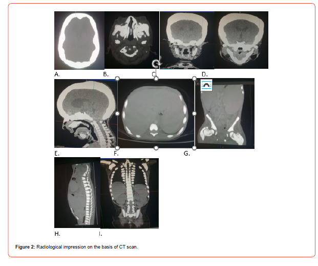 Click here to view Large Figure 2 irispublishers-openaccess-dentistry-oral-health