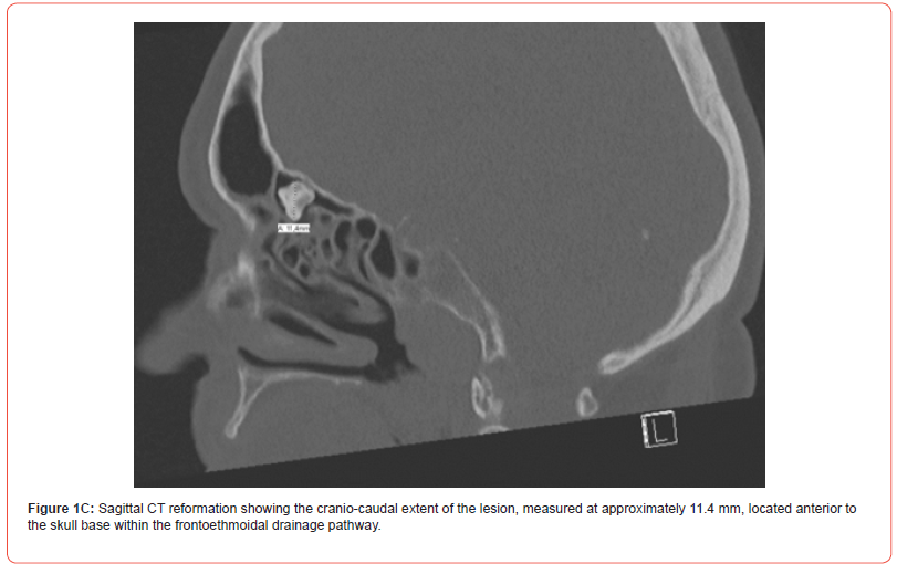 Click here to view Large Figure 3 irispublishers-openaccess-dentistry-oral-health