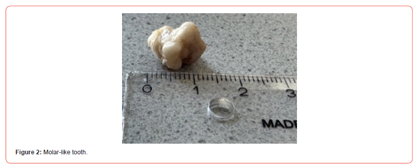 Click here to view Large Figure 4 irispublishers-openaccess-dentistry-oral-health