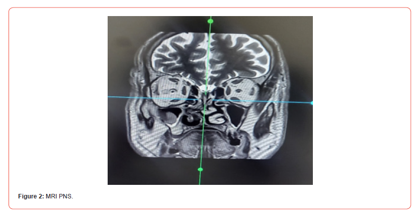 Click here to view Large Figure 2 irispublishers-openaccess-dentistry-oral-health