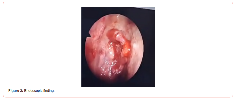 Click here to view Large Figure 3 irispublishers-openaccess-dentistry-oral-health