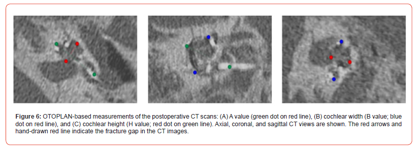 Click here to view Large Figure 6 irispublishers-openaccess-dentistry-oral-health