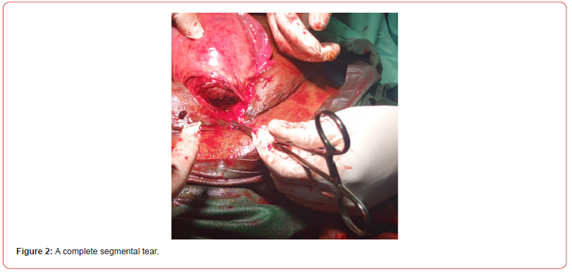 Click here to view Large Figure 2 irispublishers-openaccess-gynecology-womens-health