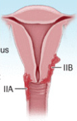 irispublishers-openaccess-gynecology-womens-health