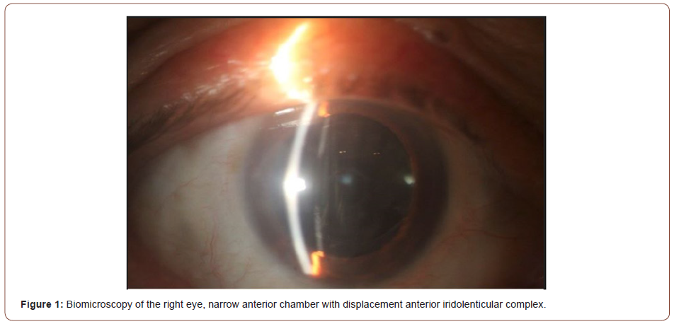 Click here to view Large Figure 1 irispublishers-openaccess-ophthalmology-vision-research