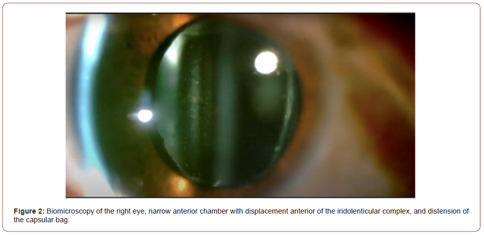 Click here to view Large Figure 2 irispublishers-openaccess-ophthalmology-vision-research