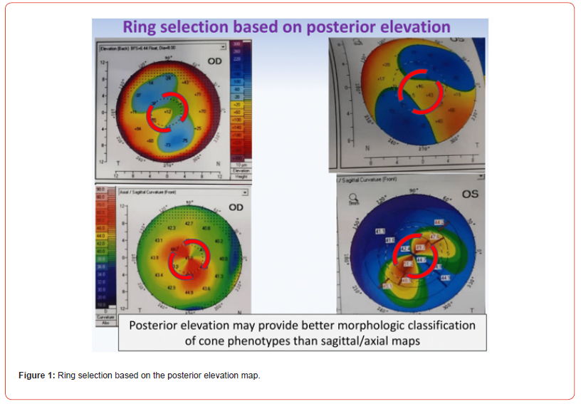 Click here to view Large Figure 1 irispublishers-openaccess-ophthalmology-vision-research