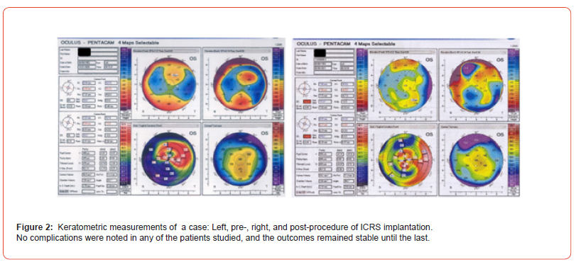 Click here to view Large Figure 2 irispublishers-openaccess-ophthalmology-vision-research