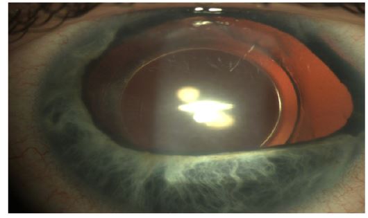 irispublishers-openaccess-ophthalmology-vision-research