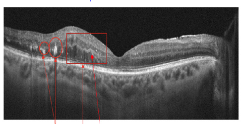 irispublishers-openaccess-ophthalmology-vision-research